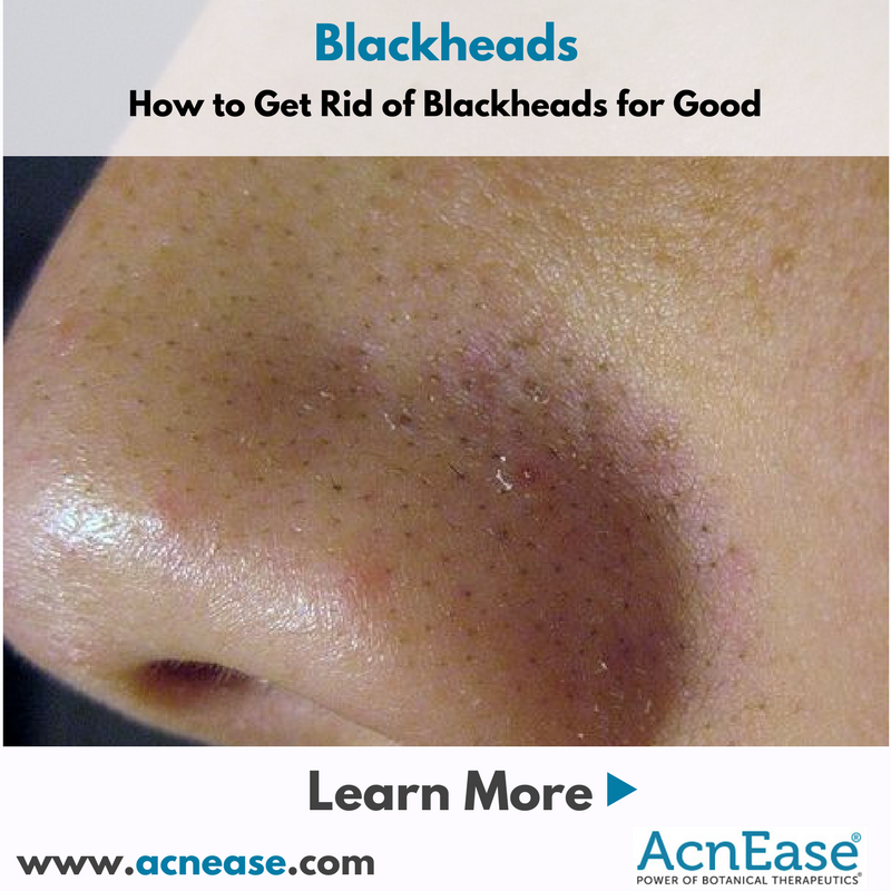 How to Get Rid of Blackheads for Good